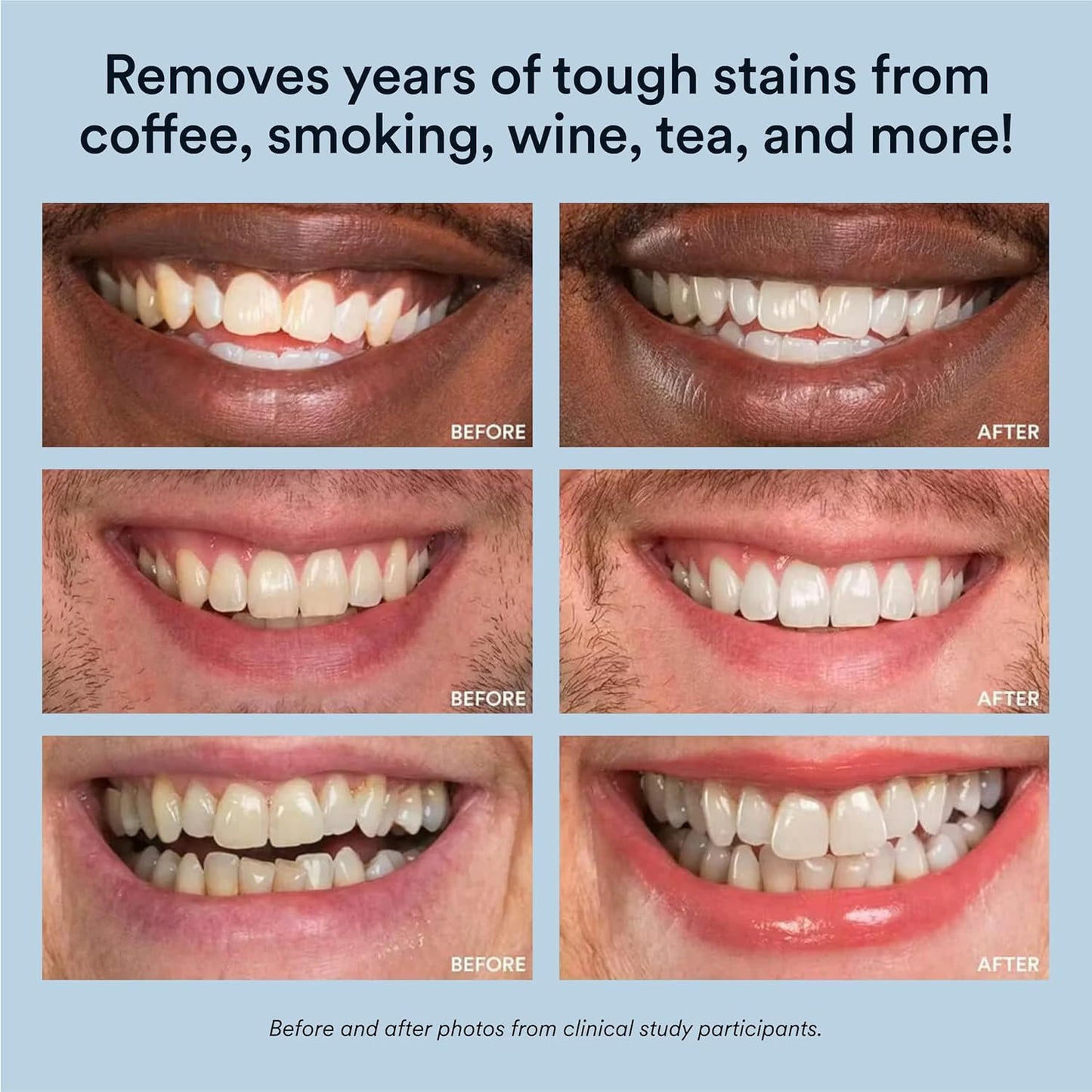 Teeth Whitening Kit, LED Accelerator Light, 35% Carbamide Peroxide Teeth Whitening Gel, 20+ Whitening Treatments, (2) 5Ml Whitening Gel Syringes, Whiten Teeth Faster